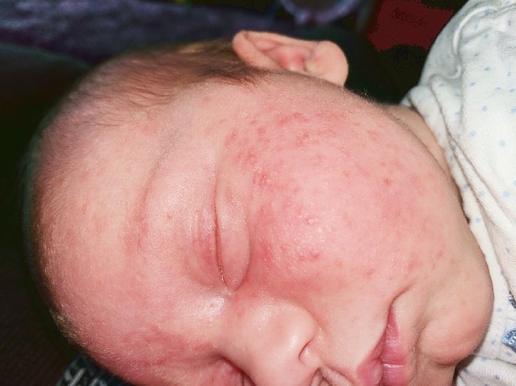 Baby displaying symptoms of CMPA, covered in an allergy rash.