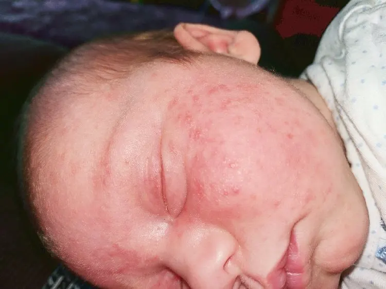a baby with a non-IgE cow's milk allergy, which would not show up in CMPA allergy testing.