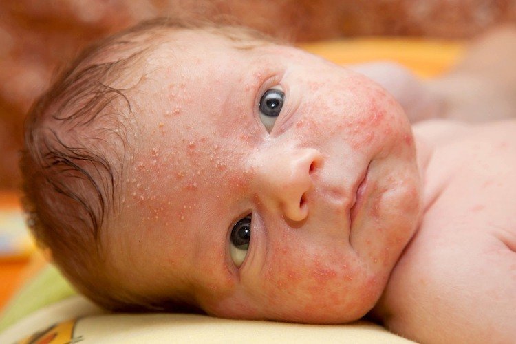 Baby with an allergy rash, likely CMPA (cow's milk protein allergy) or dairy allergy.