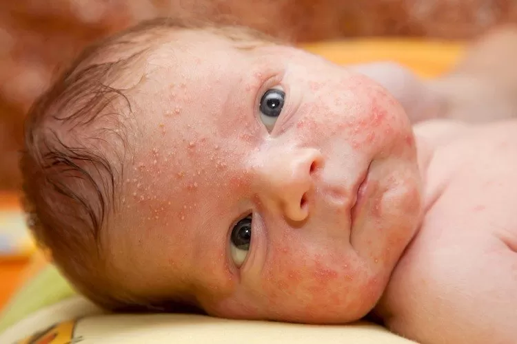 Milia vs milk allergy - this baby has a milk rash covering its face, caused be a dairy allergy. 