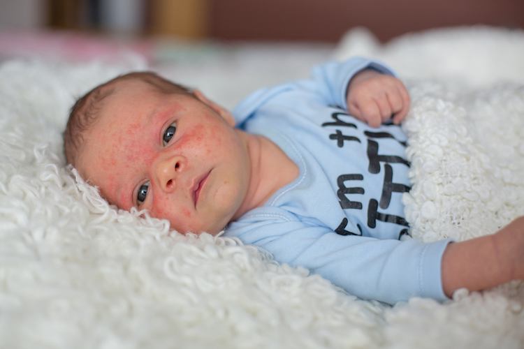 Baby milk allergy: this infant has a CMPA allergy rash on his face.