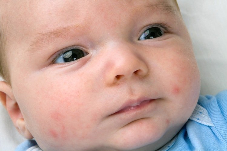 Baby showing symptoms of baby acne.