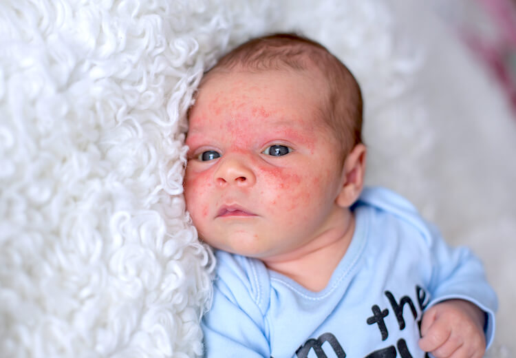 A baby with a face rash that looks like CMPA (cow's milk protein allergy).