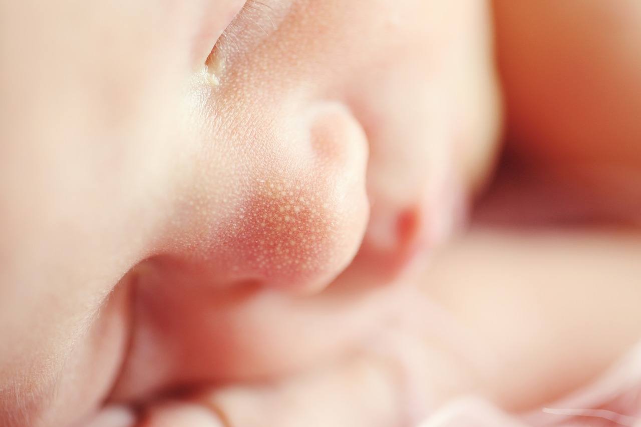 Milk rash | Image shows a close up of a baby's face.