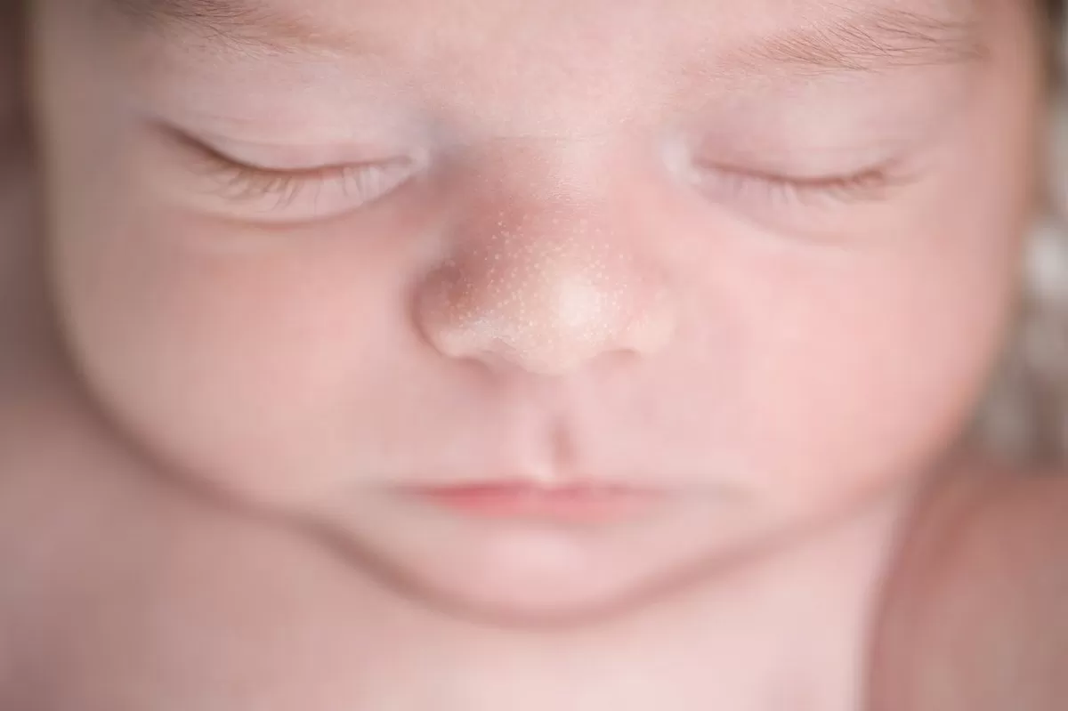 milk spots vs CMPA rash - milia Across Newborn's Nose