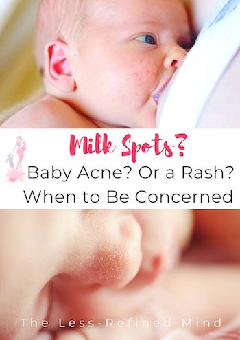 Baby acne, milk spots, or a milk rash/allergy such as CMPA? This guide will walk you through the baby rash symptoms you need to be worried about. #babyrashes #childhoodrashes #babyhealth #cmpa #parentingtips #parentingadvice