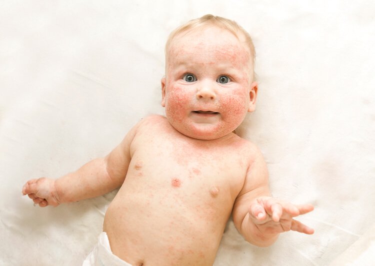 Atopic Dermatitis